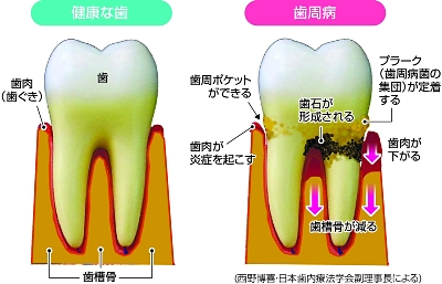 歯を失う原因1位の歯周病 歯磨きと歯石除去が基本〈老化と寿命