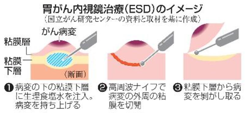 医療新世紀】早期胃がん、悪性型でも10年生存率9割超 内視鏡使った治療